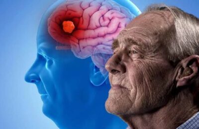 Nearly Half of Dementia Cases Could Potentially Be Prevented or Delayed